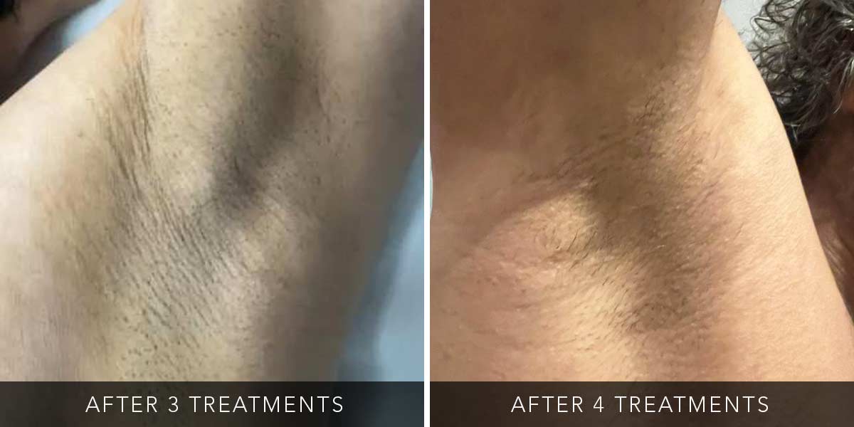 Before-After-Eneka-01