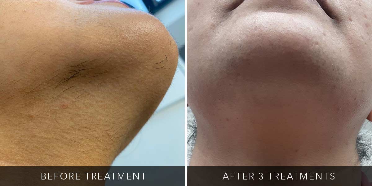 Before-After-Eneka-07