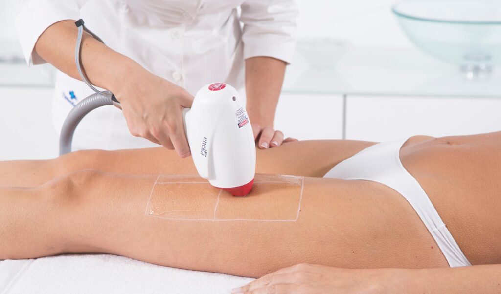legs-laser-treatment