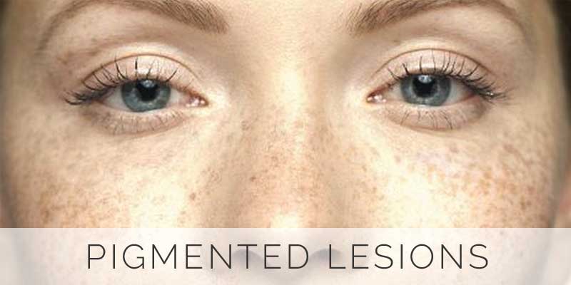 pigmented-lesions