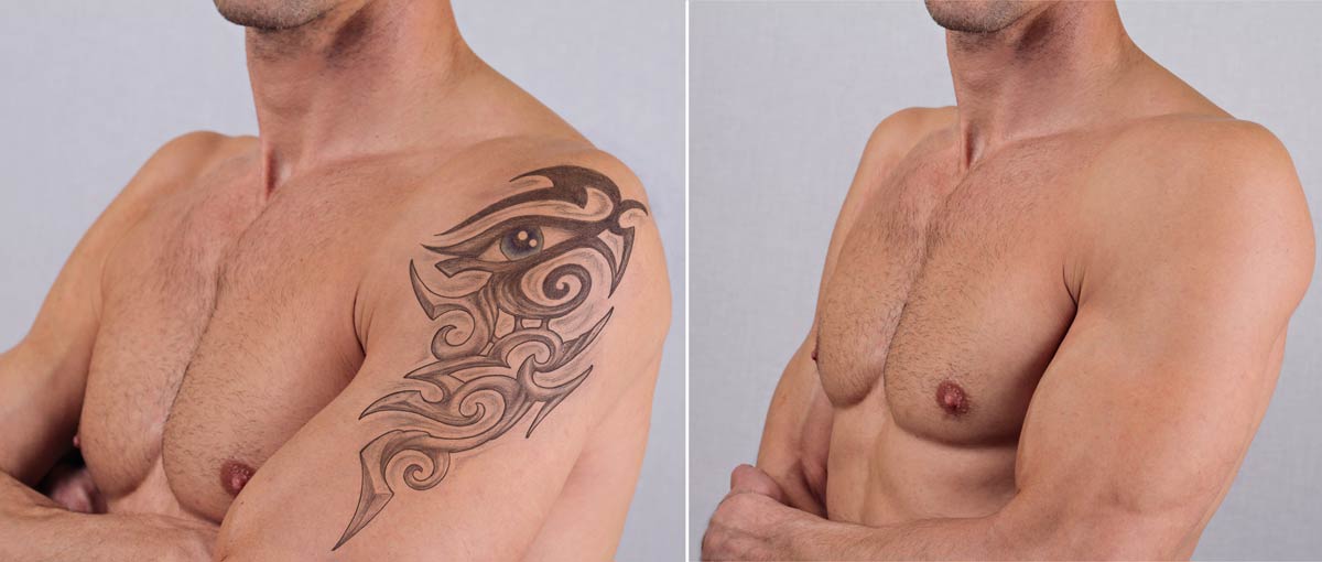 tattoo-removal