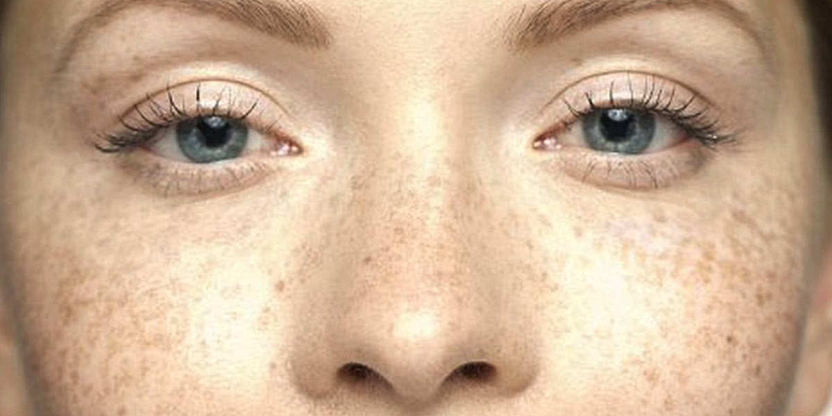 pigmented-lesions